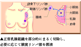 乳房円状部分切除術